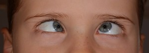 schielende Augen